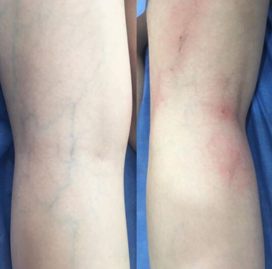 Escleroterapia1